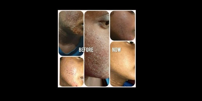 Psoriasis? You are #NotAlone